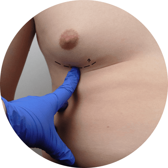 Ginecomastia Swiss Clinics