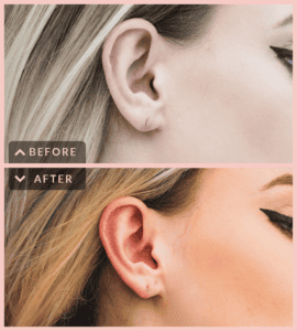 before-after-lob-ureche Swiss Clinics