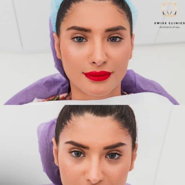 procedura-cat-eyes-la-swiss Swiss Clinics